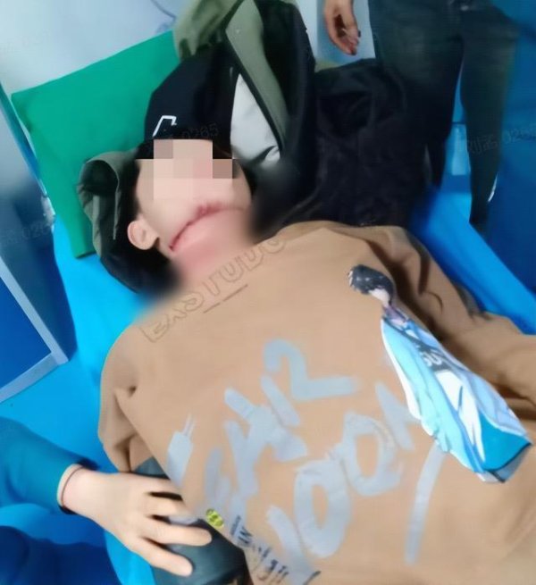 遭割喉男孩仍有一段气管未找到 社会爱心助力筹款